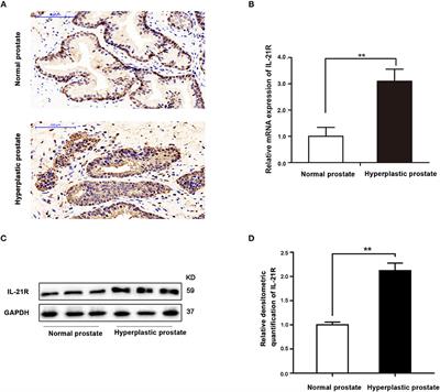 Upregulated Interleukin 21 Receptor Enhances Proliferation and Epithelial-Mesenchymal Transition Process in Benign Prostatic Hyperplasia